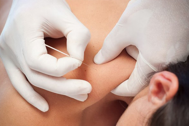 puncion seca fisioterapia rivas vaciamadrid fisiofutura puncion seca fisioterapia rivas vaciamadrid fisiofutura